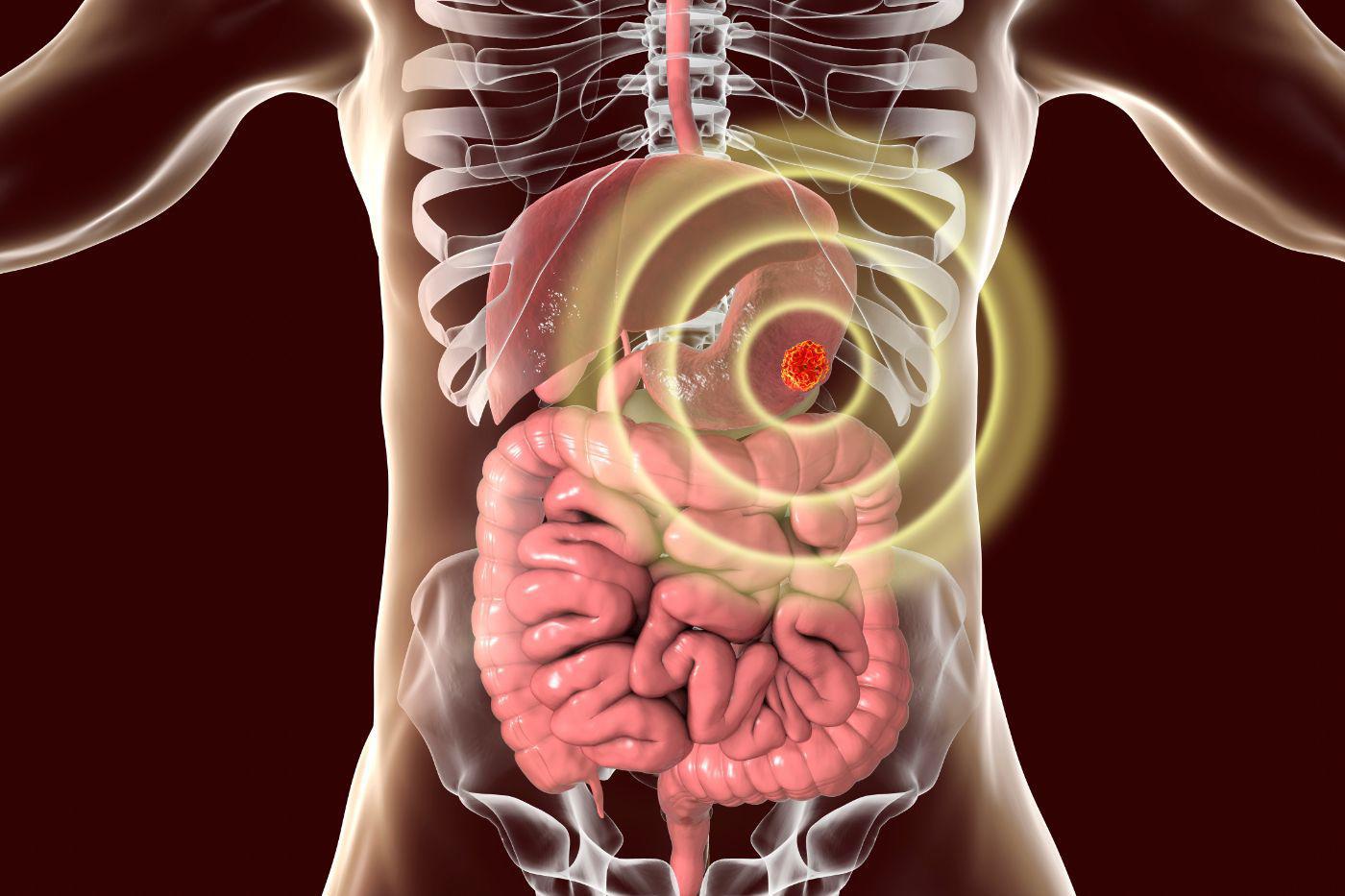 GIST Cancer Screening